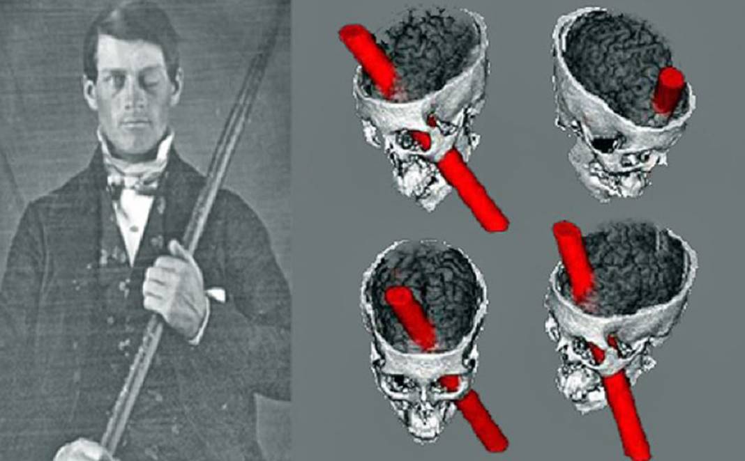 Kafatasını delen demir çubuk nedeniyle beyninin büyük bir kısmını kaybetmesine rağmen yaşamına devam eden Phineas Gage'in garip hikayesi... 2