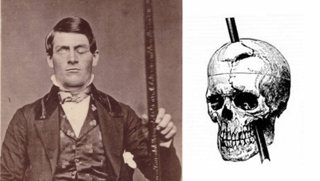 Kafatasını delen demir çubuk nedeniyle beyninin büyük bir kısmını kaybetmesine rağmen yaşamına devam eden Phineas Gage'in garip hikayesi... 3