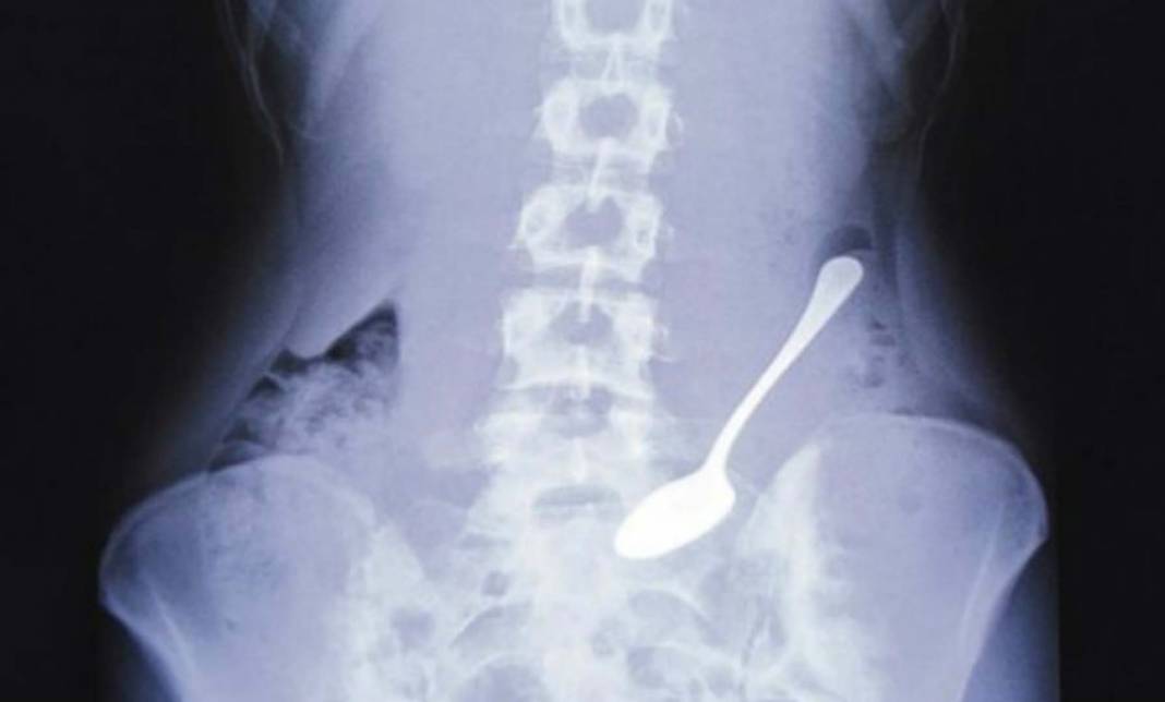 Şiddetli karın ağrısı nedeniyle hastaneye başvuran adamın midesinden çıkanlar 'Yok artık' dedirtti! Tam 53 tane... 3