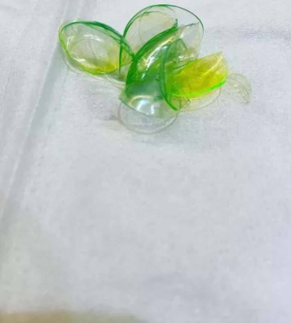 Gözünde unuttuğu lensler kabusu oldu! Doktor tam 23 tane... 5