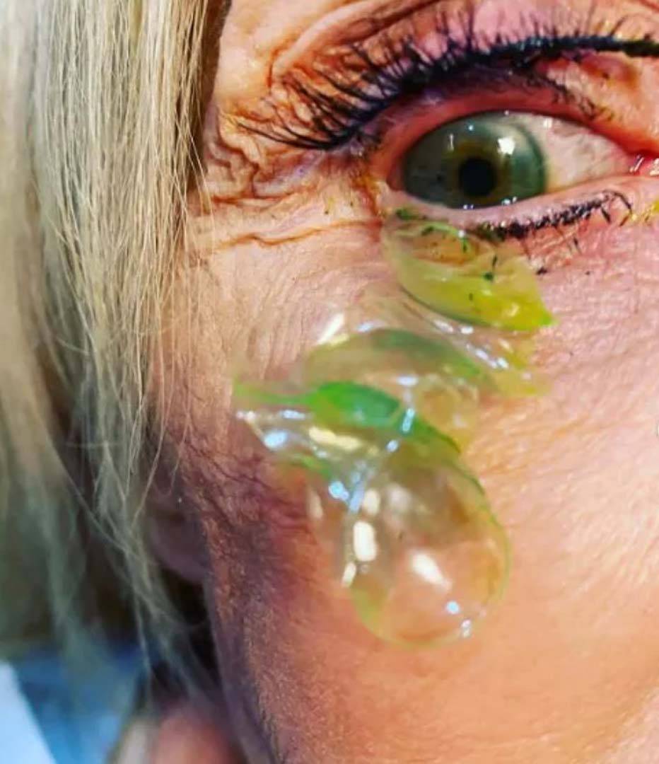 Gözünde unuttuğu lensler kabusu oldu! Doktor tam 23 tane... 6