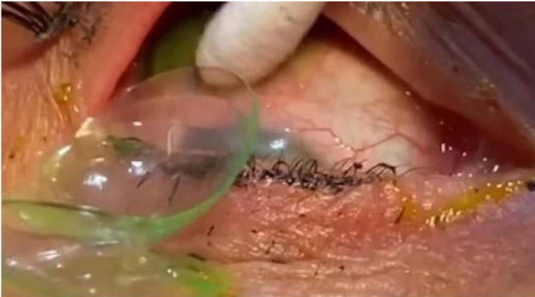 Gözünde unuttuğu lensler kabusu oldu! Doktor tam 23 tane... 7