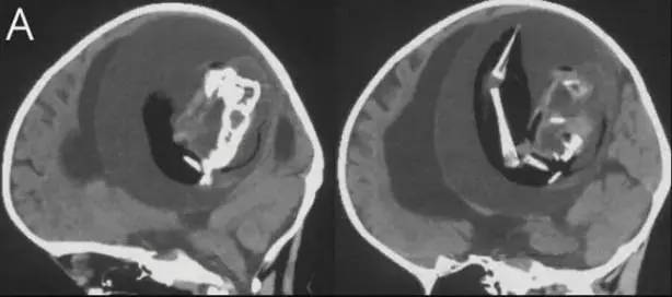 Tıp tarihinde Görülmemiş olay! 1 yaşındaki çocuğun beyninden çıkanları gören doktorlar şaştı kaldı! 3