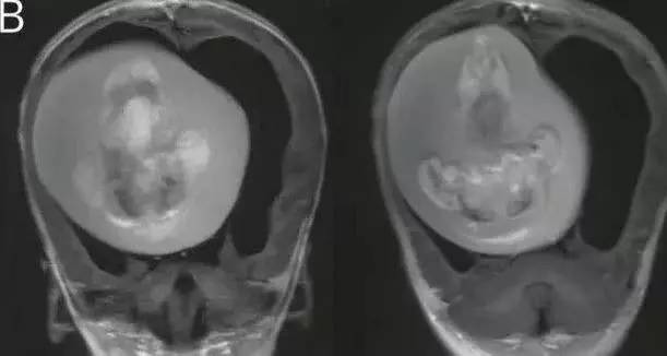 Tıp tarihinde Görülmemiş olay! 1 yaşındaki çocuğun beyninden çıkanları gören doktorlar şaştı kaldı! 4