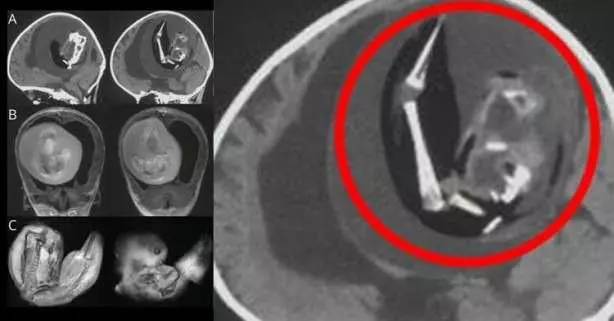 Tıp tarihinde Görülmemiş olay! 1 yaşındaki çocuğun beyninden çıkanları gören doktorlar şaştı kaldı! 5