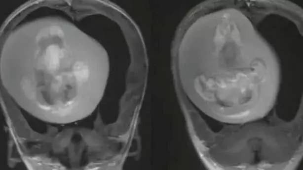 Tıp tarihinde Görülmemiş olay! 1 yaşındaki çocuğun beyninden çıkanları gören doktorlar şaştı kaldı! 7