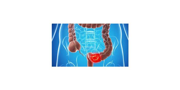 Kalın bağırsak (Kolon) kanseri Nedir, kaç senede öldürür? Kolon kanserini işaret eden en önemli 5 belirti nedir?