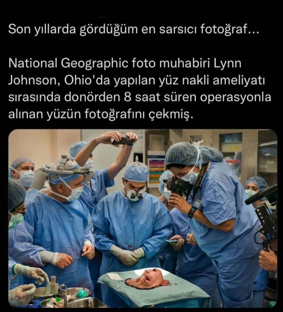 Tüyler ürperten fotoğraf! Yüz nakli ameliyatı yaptıktan sonra çekilen eski yüzün fotoğrafı görenleri korkuttu! 2