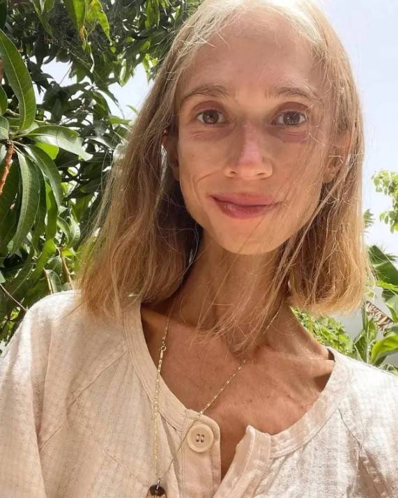 Meyve diyetiyle 20 kiloya düşmüştü: O, Sosyal medya fenomeni hayatını kaybetti! 1