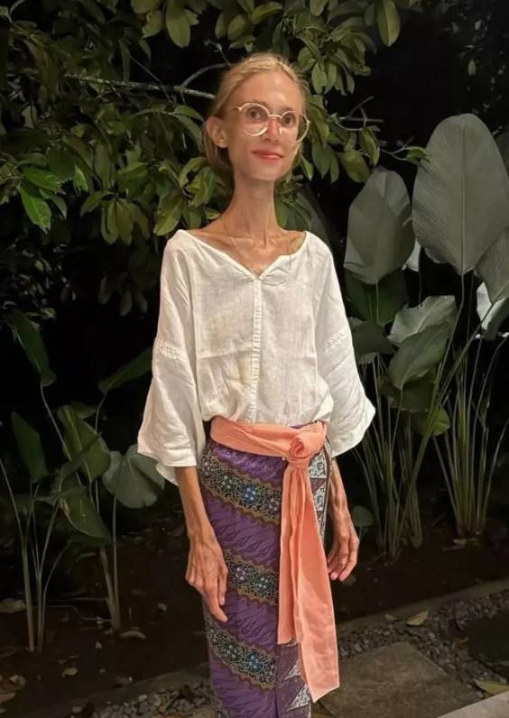 Meyve diyetiyle 20 kiloya düşmüştü: O, Sosyal medya fenomeni hayatını kaybetti! 2