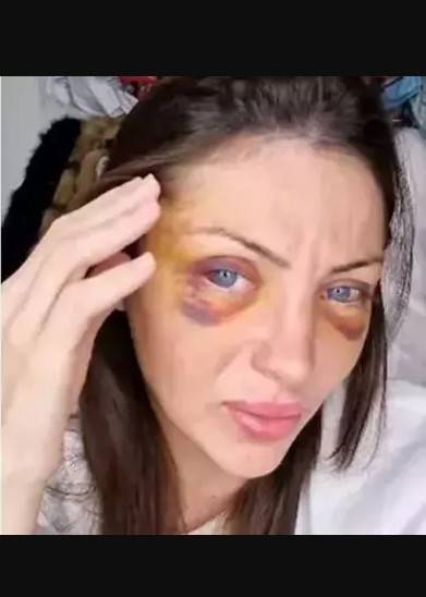 Barbie'ye benzeme sevdası canından etti: 27 kez ameliyat olan Fenomenin gizemli ölümü! 5