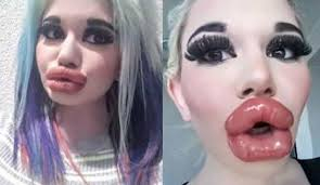 22 yaşındaki genç kız yaptırdığı dudak dolgularıyla tanınmaz hale geldi 12