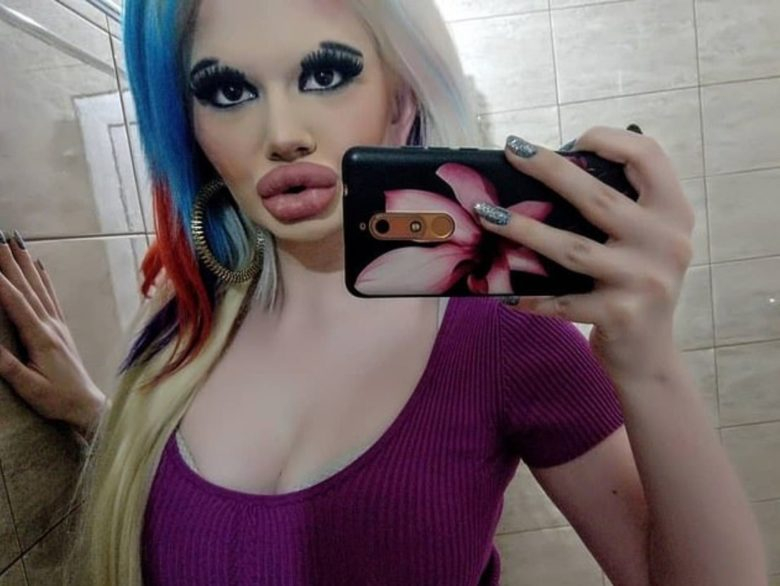 22 yaşındaki genç kız yaptırdığı dudak dolgularıyla tanınmaz hale geldi 2