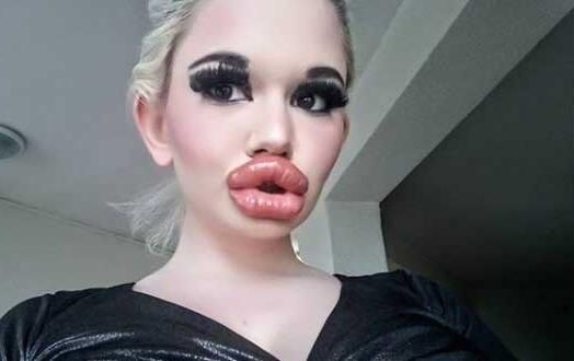 22 yaşındaki genç kız yaptırdığı dudak dolgularıyla tanınmaz hale geldi 3