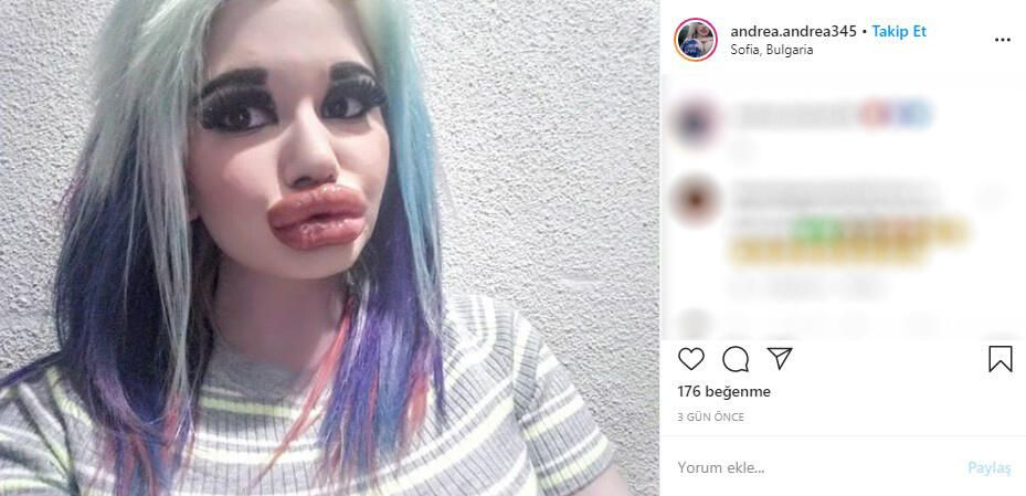 22 yaşındaki genç kız yaptırdığı dudak dolgularıyla tanınmaz hale geldi 5