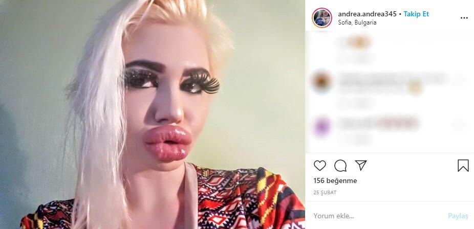 22 yaşındaki genç kız yaptırdığı dudak dolgularıyla tanınmaz hale geldi 7