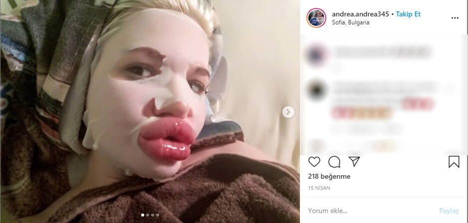 22 yaşındaki genç kız yaptırdığı dudak dolgularıyla tanınmaz hale geldi 8