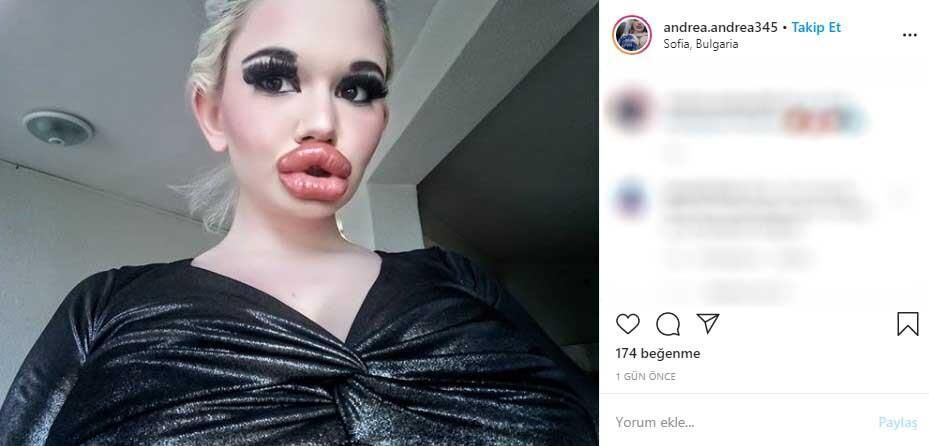 22 yaşındaki genç kız yaptırdığı dudak dolgularıyla tanınmaz hale geldi 9