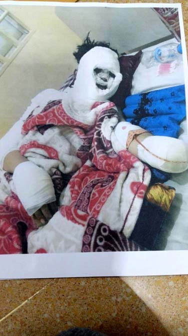 Ayrılmak isteyen kız arkadaşının yüzüne kezzap atıp kolunu satırla kesti 4