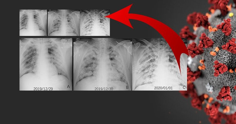 Koronavirüste geleceği görmek mümkün: Artık hastalığın seyrini izleyebileceğiz! 2