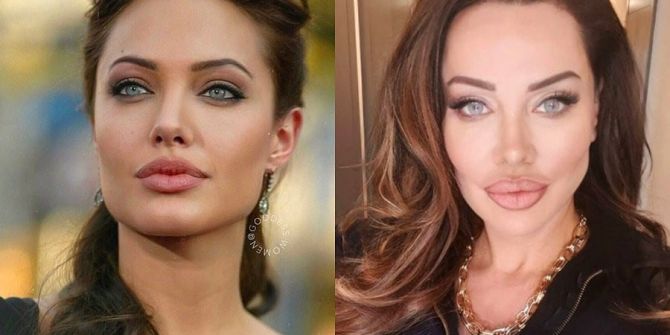 Yerli Angelina Jolie olarak bilinen Umut Akyürek, yüzüne yaptırdığı operasyonla bambaşka biri oldu!