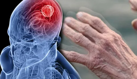 Uzmanından "akrabalarda parkinson öyküsü bulunan kişilerde hastalığın görülme oranı daha yüksek"