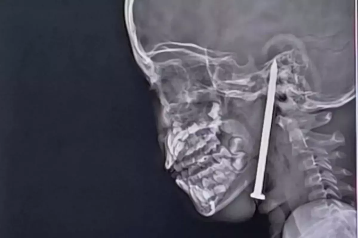 Beynine 8 santimetrelik çivi saplandı: 7 yaşındaki bir kız çocuğunun mücize kurtuluşu!
