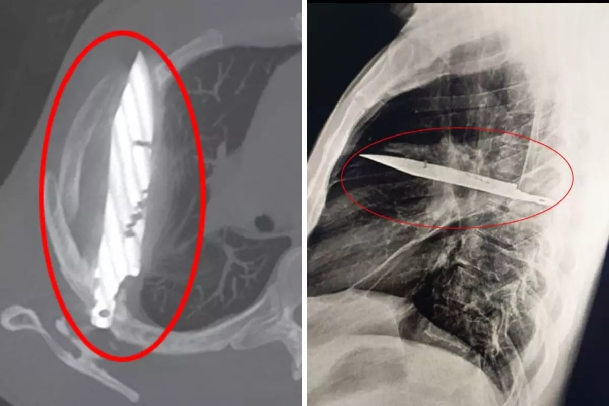 Göğüs ağrısıyla hastaneye gitti, gözlerine inanamadı: Göğsünde 8 yıldır av bıçağıyla yaşadığı ortaya çıktı!