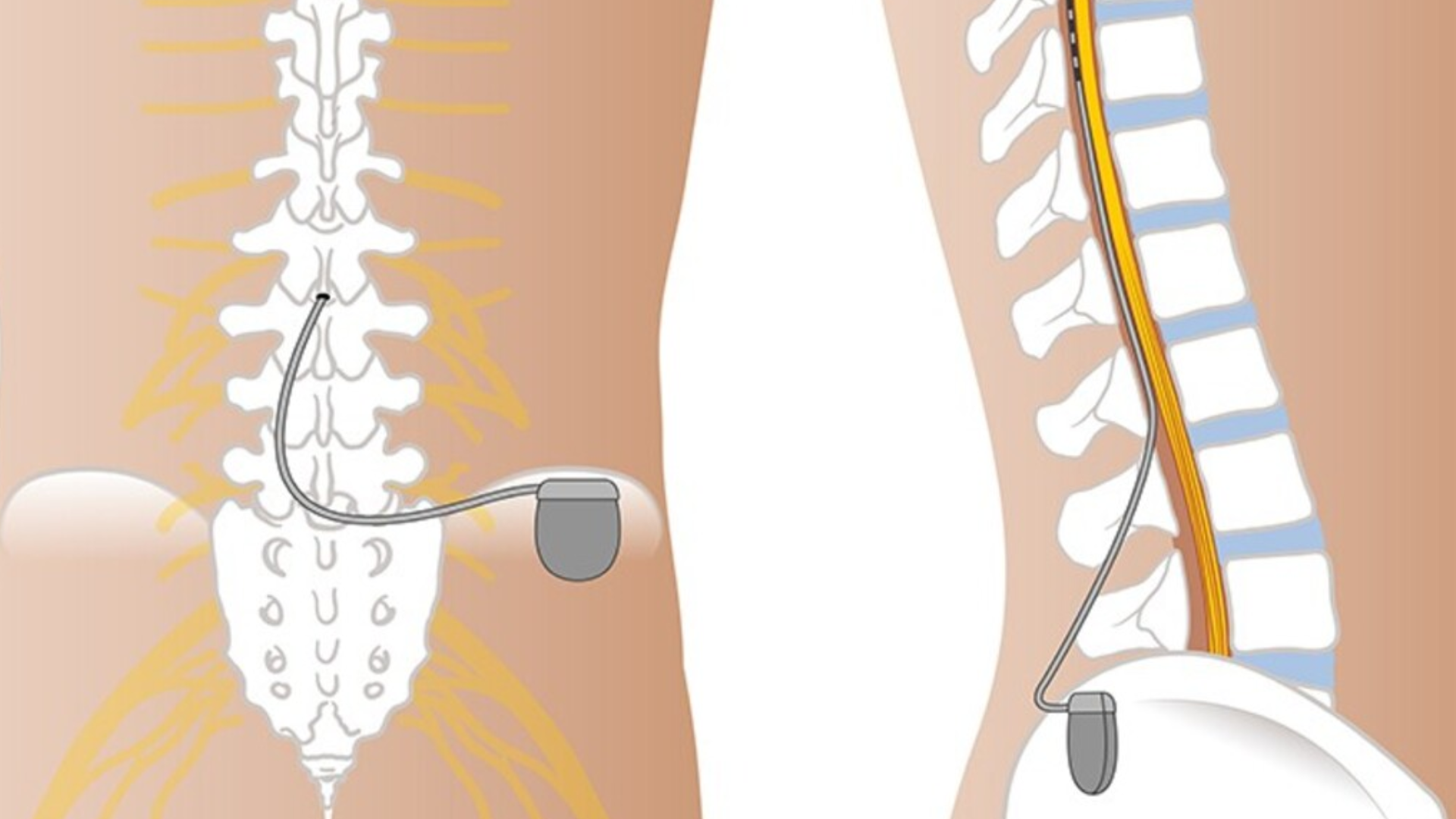 Özel Bölge Hastanesi bilgilendiriyor: Epidural stimülasyon (EES) nedir ve omurilik yaralanmaları tedavisinde nasıl uygulanır?