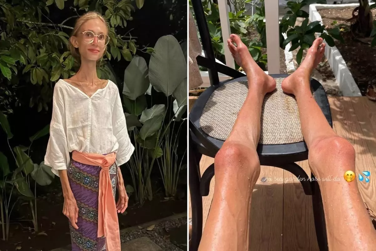 Meyve diyetiyle 20 kiloya düşmüştü: O, Sosyal medya fenomeni hayatını kaybetti!