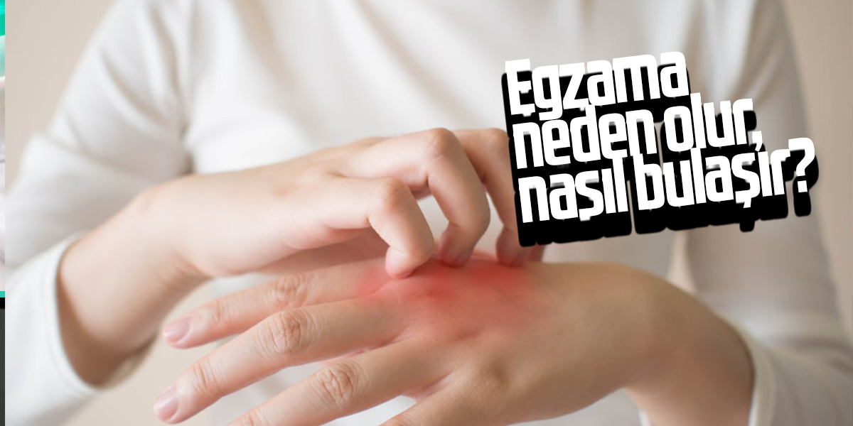 Egzama neden olur, nasıl bulaşır? Egzamanın belirtileri nelerdir?