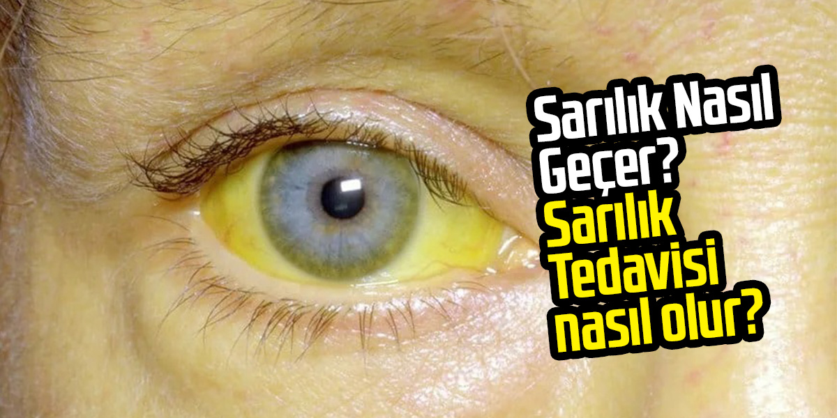 Sarılık Nasıl Geçer? Sarılık Tedavisi nasıl olur?