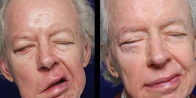 Yüz felci nedir? Neden olur? Kaç günde geçer? | Yüz felci belirtileri, tedavisi, duası