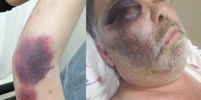 Antalya'da yüzde 90 engelli adamı öldüresiye darp ettiler