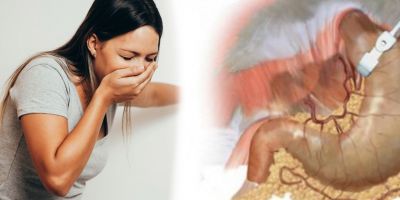 Dumping Sendromu nedir? Dumping Sendromu belirtileri nelerdir?