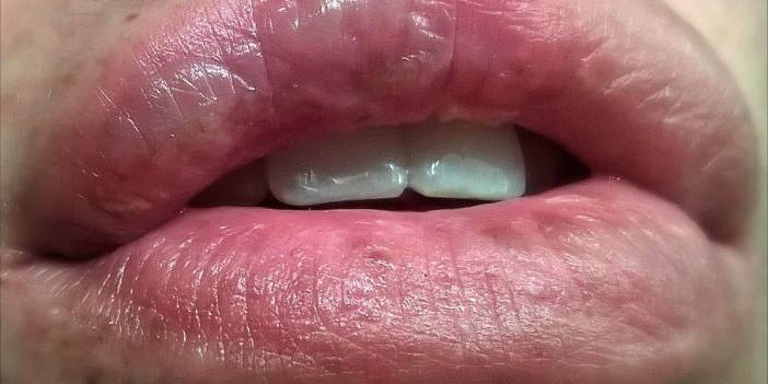 Dudak Kanseri Belirtileri Nelerdir? Dudak Kanseri Fotoğrafları