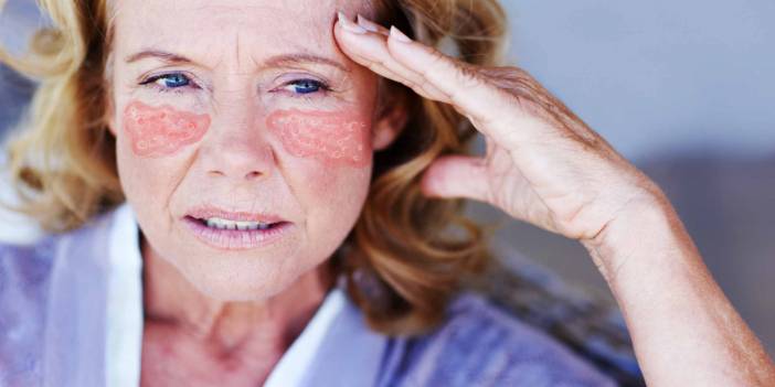 Lupus Hastalığı Nedir? Belirtiler Nelerdir?