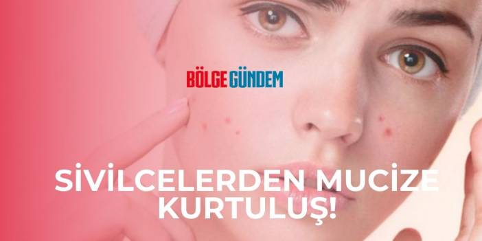 Sivilcesi Olanlar Dikkat! İşte Sır Gibi Saklanan Sivilceden Kurtulma Yöntemleri.