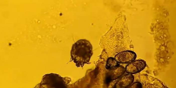 Alışveriş merkezlerine dikkat! Uyuz vakaları arttı, her gün yeni bir vaka görülüyor!