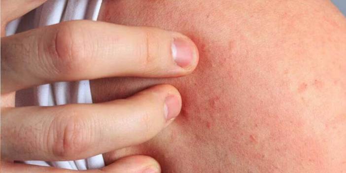 Histamin Nedir, Histamin alerjisi belirtileri nelerdir sağlığımıza faydası nedir, vücudumuza zararı var mıdır?