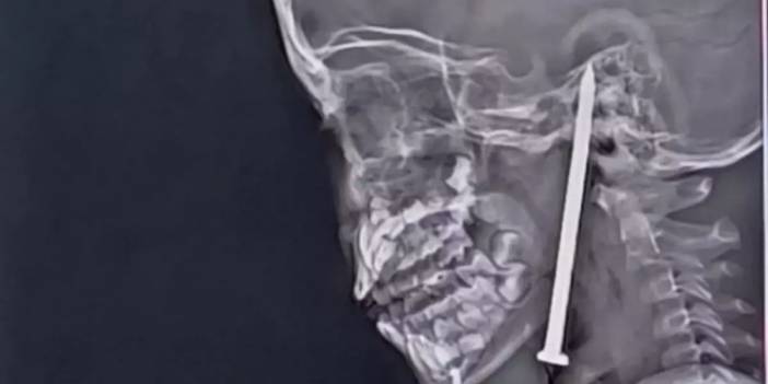 Beynine 8 santimetrelik çivi saplandı: 7 yaşındaki bir kız çocuğunun mücize kurtuluşu!