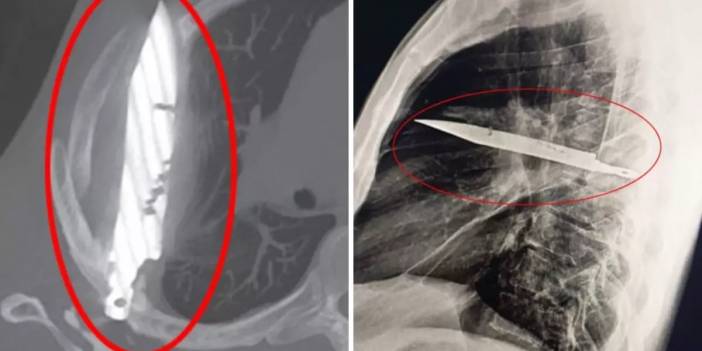 Göğüs ağrısıyla hastaneye gitti, gözlerine inanamadı: Göğsünde 8 yıldır av bıçağıyla yaşadığı ortaya çıktı!