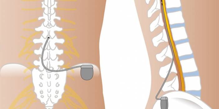 Özel Bölge Hastanesi bilgilendiriyor: Epidural stimülasyon (EES) nedir ve omurilik yaralanmaları tedavisinde nasıl uygulanır?
