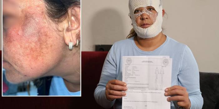 Yaptırdığı "Prenses cilt bakımı" yüzünü öyle bir hale soktu ki: Oğlum bana "öcü" diyor!
