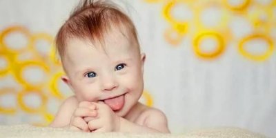 Down sendromu nedir? | Down sendromu genetik mi?