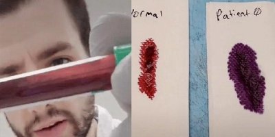 TikTok'ta kan tüpü videosu! Bir doktor korona virüslü kan örneği paylaştı