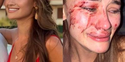 Dünyaca ünlü modele plajda dayak! Yaşadığı şiddeti dünyaya duyurdu