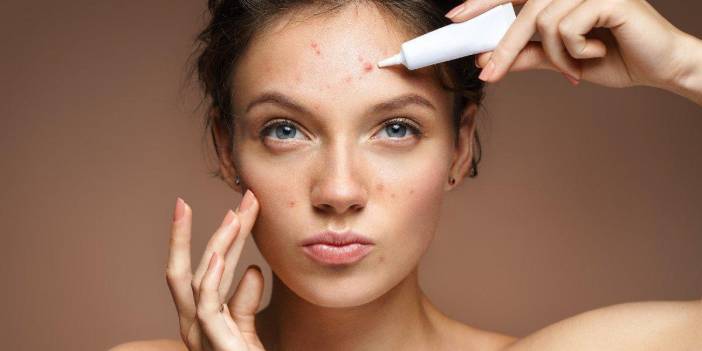 Sivilce Neden Çıkar? Alında Yanakta Sivilce Neden Çıkar?