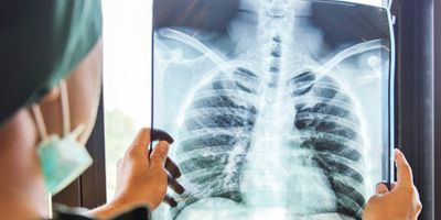 Korkutan açıklama: Koronavirüs salgını zatürre kaynaklı ölümleri artırdı