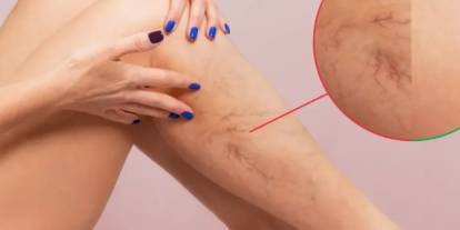 Özel Pendik Bölge Hastanesi bilgilendiriyor: Variste Termal Ablasyon Tedavisi nasıl yapılır?